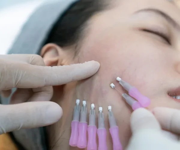 Thread Lifts vs. Surgical Facelifts: Pros and Cons